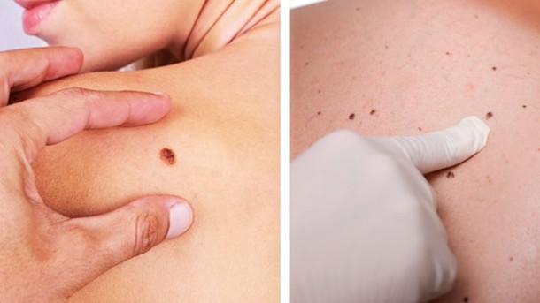 El cáncer de piel ocupa el cuarto lugar de frecuencia en el mundo